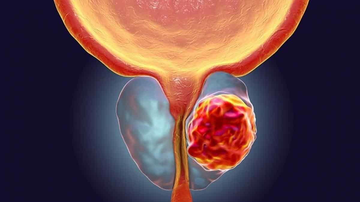¡Tú puedes prevenir el cáncer de próstata! Te decimos cómo