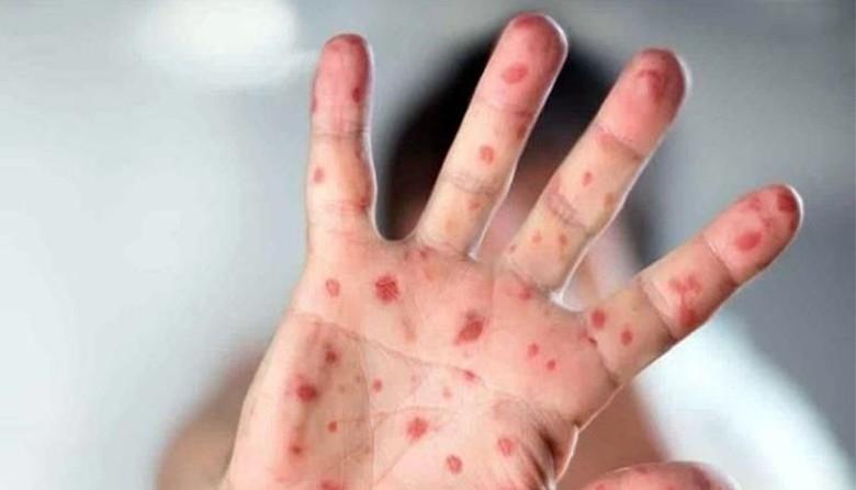 Secretaría de Salud Federal revela que viruela símica afecta mayormente a hombres