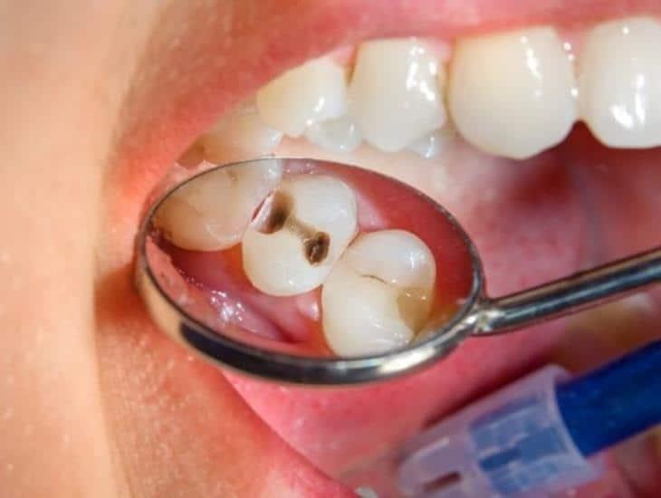 Graves problemas de higiene dental en veracruzanos; más del 90% tiene caries