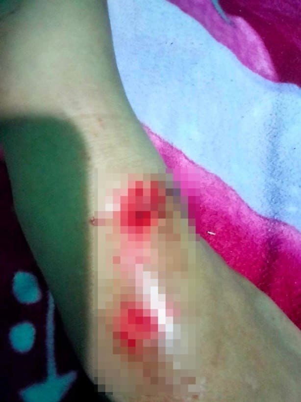 Joven sufrió ataque de un pitbull en Moloacán
