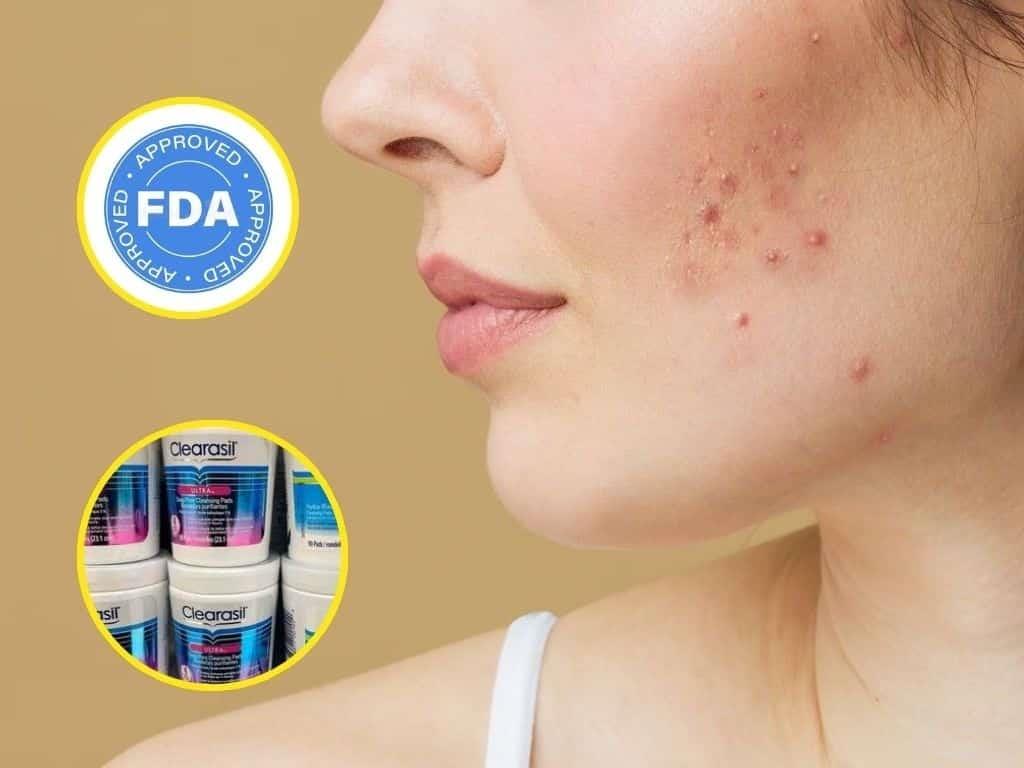 Alerta FDA de productos para el acné con sustancia cancerígena