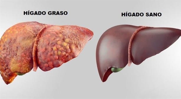 ¿Cuáles son los síntomas de un hígado enfermo?