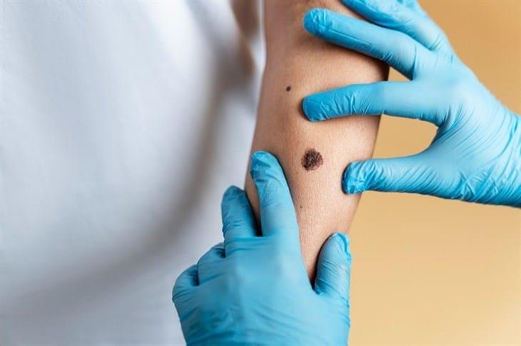IMSS Veracruz Norte advierte las siguientes medidas de prevención contra el melanoma